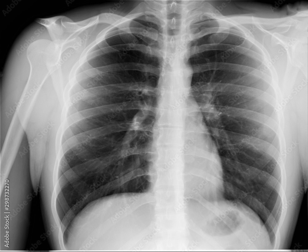 normal radiography of the chest and lungs,pulmonology, medical ...