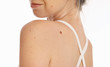 © dream@do - Woman with birthmark on her back, skin. Checking benign moles. Skin tags removal