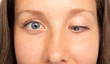 © Alessandro Grandini - Young woman with strabismus, ophthalmic problem
