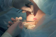 © familylifestyle - Surgeon man sutures ankle during surgery with neat stitches after removing hygroma, hands closeup. Doctor sewing on wound in operating room in hospital. Seams with self-absorbable threads.