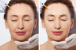 Forehead plastic surgery before and after. Middle age woman wrinkled face close up. Facial contouring, anti aging fillers concept. Mature female making beauty collagen procedure. Facelift before-after