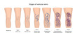 Stages of varicose veins: spider, reticular, nodes, swelling, discoloration skin, eczema, trophic ulcer. Image of healthy and diseased legs. Vector illustration in flat style with main description.
