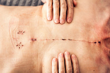 Scar From Open Heart Surgery On The Female Body, Where The Sternum Was Cut In Two, And The Rib Cage Sprung. Image Taken 30 Days (1 Month) Following Surgery.