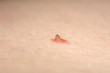 © dimas830 - papilloma nevus or mole on human skin