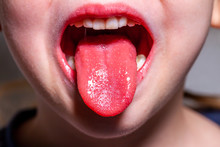 Tongue Of A Child With Scarlet Fever - Strawberry Tongue