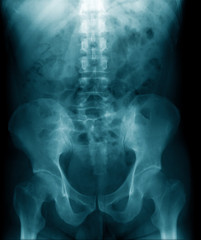 Poster - x-ray image of human spine and show lumbar spondylosis