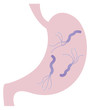 ピロリ菌に感染した胃