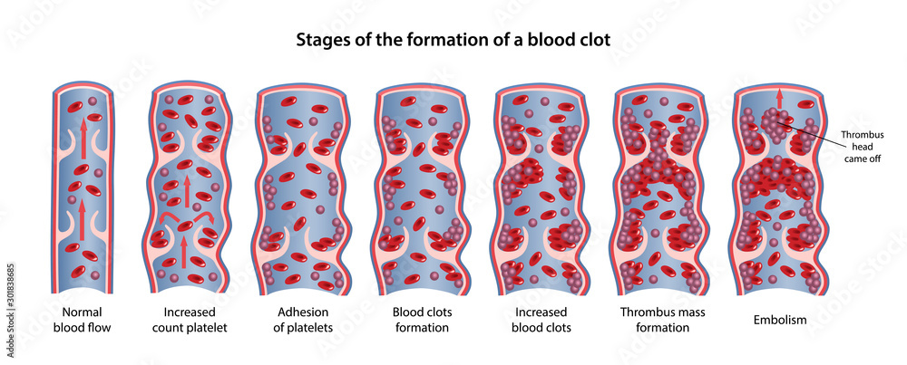 Stages of the formation of blood clot: increased count platelet ...