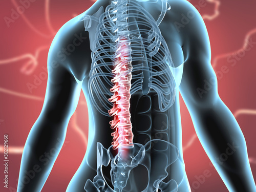 Fotografía Spinal cord injury concept. 3d illustration.
