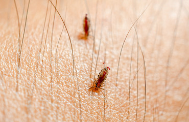 louse, head lice feed on blood on human skin.