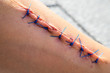 © rawcaptured - Wound with suture after surgery