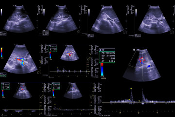 Sticker -  Collection  of Ultrasound upper abdomen showing anatomical of  hepatobiliary system and Liver and gall bladder for screening hepatic cell carcinoma of hcc. clipping Path