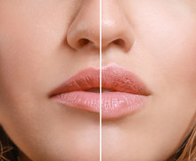 Young Woman Before And After Lip Enhancement, Closeup