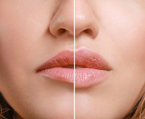 Canvas Print - Young woman before and after lip enhancement, closeup