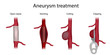 Aneurysm treatment. Clipping, open surgery repair, stenting, coiling. Medical anatomy illustration.