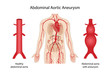 Abdominal aortic aneurysm. Arterial circulatory system of the abdominal. Healthy abdominal aorta and abdominal aorta with aneurysm. Vector illustration in flat style isolated on white background