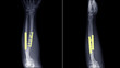 Film X-ray forearm radiograph show forearm both bone broken(shaft of Ulna and Radius fracture) treated by surgery and fixation(ORIF) with plate and screw. Highlight on medical implant. Image concept