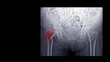 Film X-ray hip radiograph show broken hip bone (intertrochanteric fracture of femur)l. Elderly patient has osteoporosis and traumatic injury at home. nursing care and fall prevention concept.