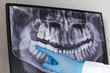 Doctor points wisdom tooth in dental x-ray