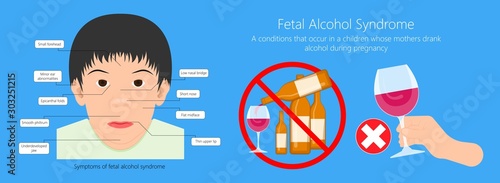 Fotomural Fetal alcohol spectrum syndrome disorders conditions mother drank during pregnan