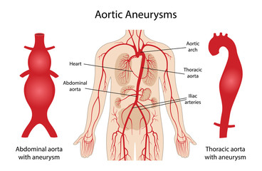 Wall Mural - Aortic aneurysms: Thoracic and Abdominal. Arterial circulatory system of the abdominal. Abdominal aorta and thoracic aorta with aneurysm. Vector illustration in flat style isolated on white background