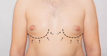 Male Body, Male Breast Plastic, Gynecomastia. Male Breast Adjustment, Plastic Surgery, Background, Medical