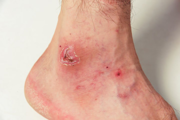 Skin injury after falling from a motorcycle on a man's leg. Skin lesions on the man's body. Abrasion and trauma on white skin