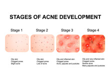 Stages Of Development Of Acne. Inflamed Skin With Scars, Acne And Pimples. The Texture Of Inflamed Skin, And Acne And Pimples. Infographics. Vector Illustration.