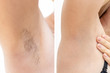 Woman underarms, armpit before and after depilation, laser waxing and sugaring