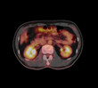 PET CT Scan fusion image