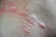 © ooddysmile - urticaria on skin. rashes, of which urticaria and toxic erythema are the most common.
