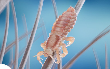 3d rendered illustration of a head louse on a human head