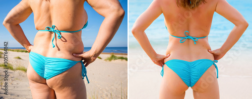 Cuadros en Lienzo Woman in bikini from back before and after weight loss