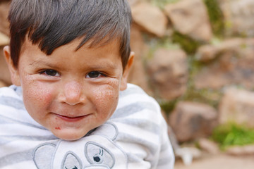 Happy little latin boy with damaged face skin.