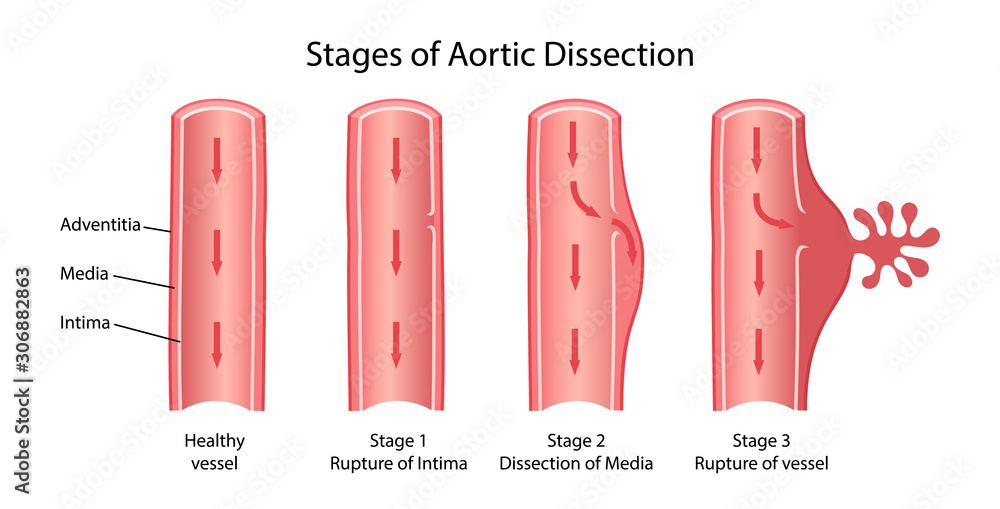 Sorta Disection Vector de Stock Stages of aortic dissection: rupture Intima, dissection ...