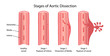 Stages of aortic dissection: rupture Intima, dissection Media, rupture vessel. Image of healthy and damaged aorta. Vector illustration in flat style with main description isolated on white background