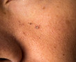 mole nevus nevo on the skin face