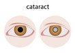 © gritsalak - cataract in eye vector