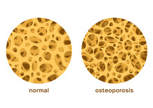 Osteoporosis Bone Graphic Vector / Low Density Human Calcium / Anatomy