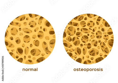 Fotografía osteoporosis bone graphic vector / low density human calcium / anatomy