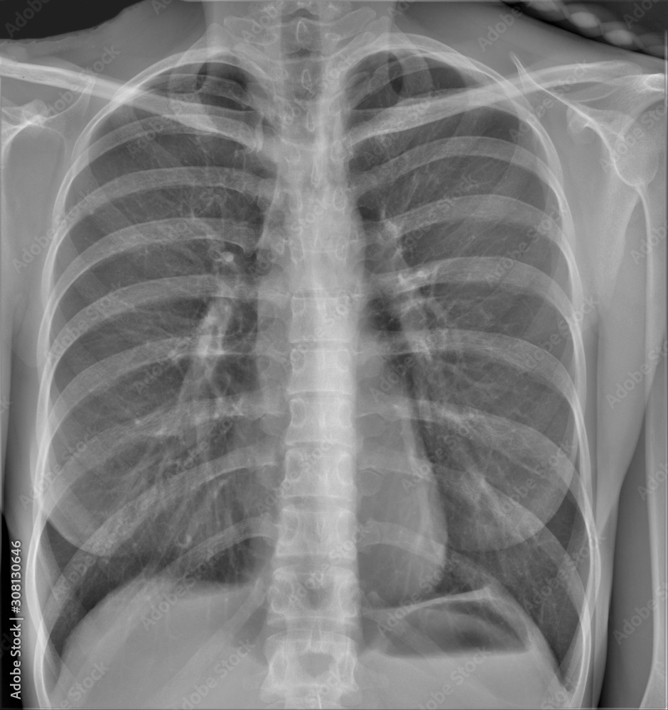 Normal Radiography normal radiography of chest organs in direct projection, pulmonology ...