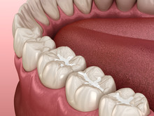 Molar Fissure Dental Fillings, Medically Accurate 3D Illustration Of Dental Concept