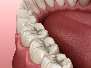 Prepareted Molar Fissure for fillings placement, Medically accurate 3D illustration of dental concept