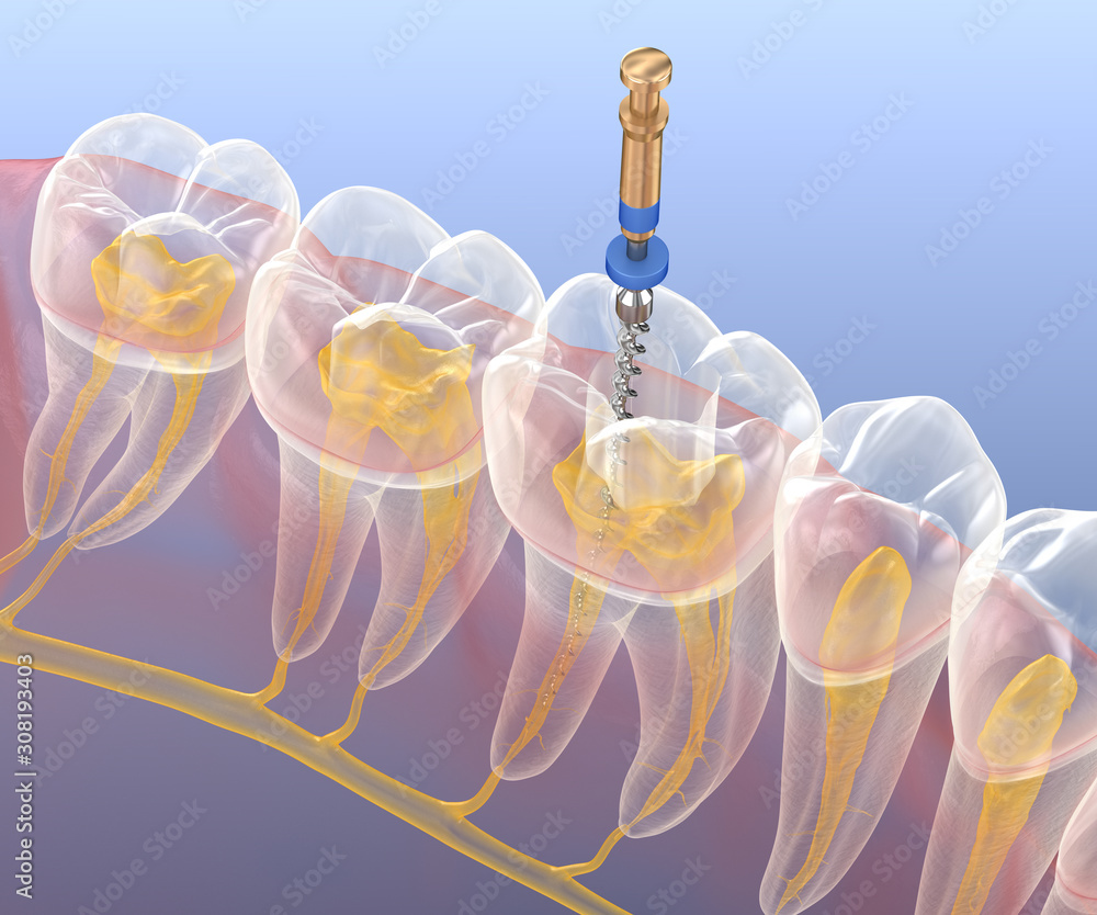 Endodontic root canal treatment process. Medically accurate tooth 3D ...