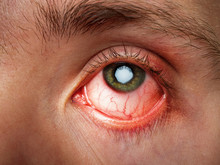 Conjunctivitis, Conjunctival Inflammation, Red Eyes, Infection And Inflammation, Close Up Eye