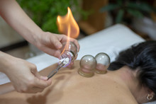 Acupuncture Therapist Setting A Fire Cupping Glass On The Back Of A Young Woman