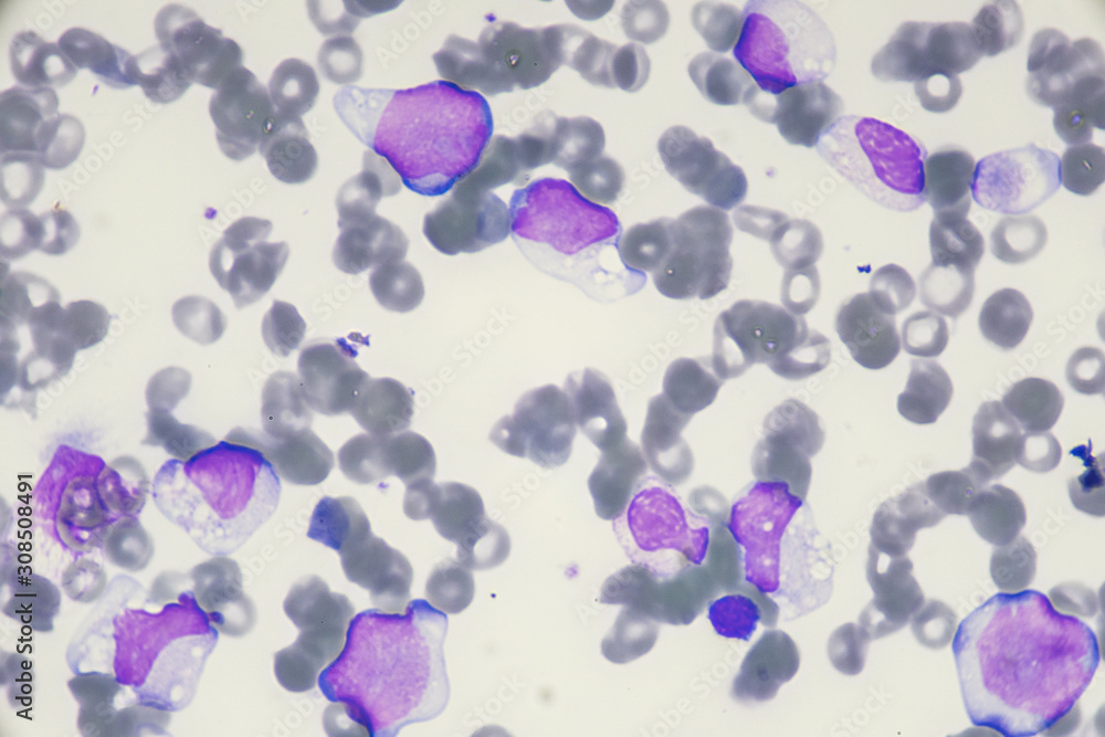 Blast cell in Acute myeloid leukemia from human blood cells (White ...