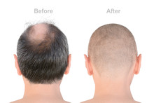 Hair Loss. Before And After Transplantation. Rear View Of Male Bald Head On White Background, Isolated