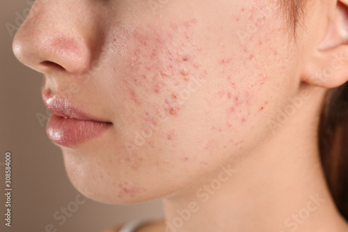 Fotografía Teenage girl with acne problem on beige background, closeup