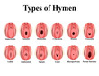 Types of hymen. Imperforate, annular, Denticular, Cribriform, dentate, Crescentic, Labial, Fimbriated, Septate, lunar, Microperforate. Hymen after defloration. Infographics. Vector illustration.